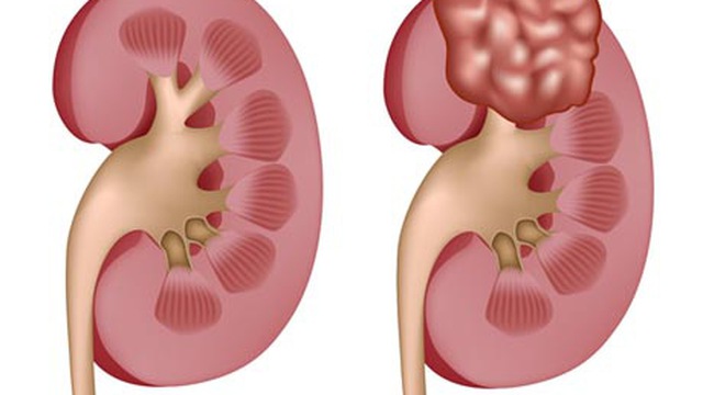 chụp nhũ ảnh 2 chụp nhũ ảnh 2