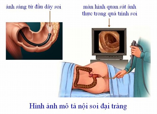 Nội soi đại tràng có nguy hiểm không? - Giải đáp Nội soi đại tràng có nguy hiểm không? - Giải đáp