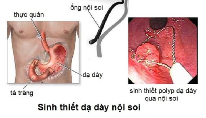 Nội soi dạ dày và sinh thiết là gì? Nội soi dạ dày và sinh thiết là gì?