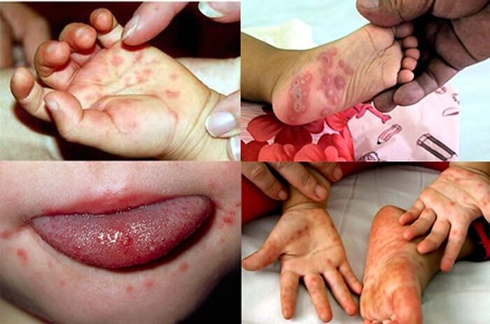 Nguyên nhân bệnh tay chân miệng ở trẻ -1