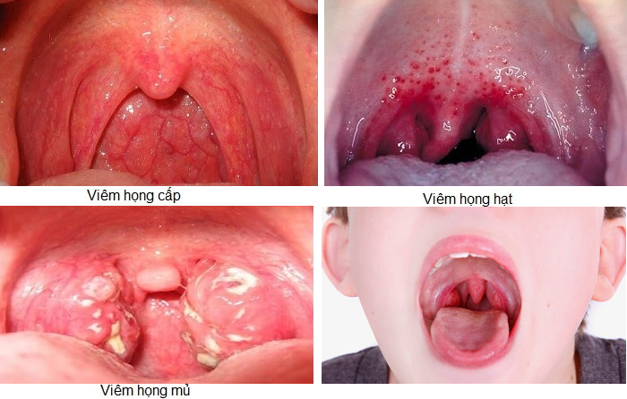 Viêm họng ở trẻ em - Nguyên nhân, Triệu chứng và Cách điều trị -2 Viêm họng ở trẻ em - Nguyên nhân, Triệu chứng và Cách điều trị -2