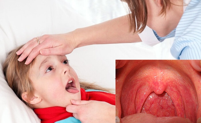 Điều trị viêm họng cấp ở trẻ em như thế nào thì hiệu quả? -1 Điều trị viêm họng cấp ở trẻ em như thế nào thì hiệu quả? -1