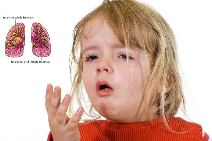 Viêm phổi ở trẻ em - Nguyên nhân và cách điều trị hiệu quả-1