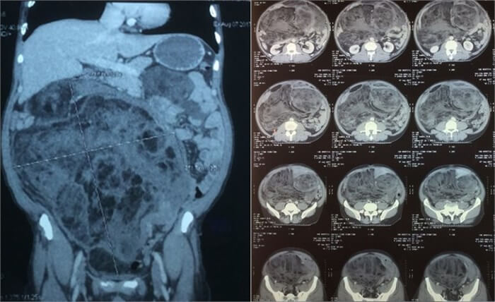 Chụp CT ở ổ bụng Chụp CT ở ổ bụng