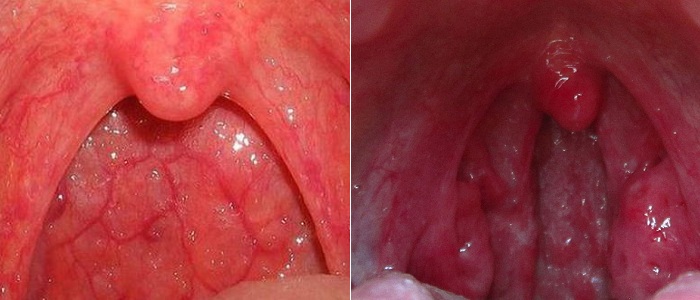 Viêm họng hạt ở trẻ -3 Viêm họng hạt ở trẻ -3