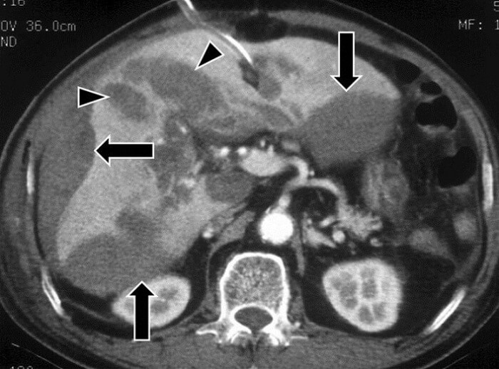 Chụp CT gan Chụp CT gan