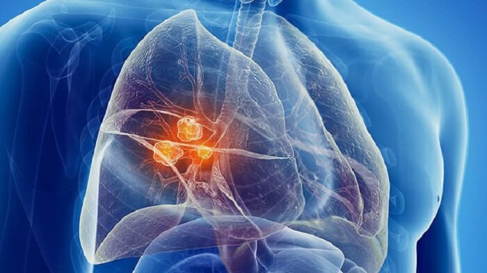 Chẩn đoán Ung thư phổi bao gồm các phương pháp