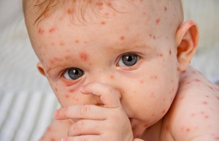 Các dấu hiệu nhận biết bệnh thủy đậu ở trẻ em