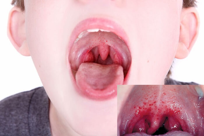 Viêm họng hạt ở trẻ em -1