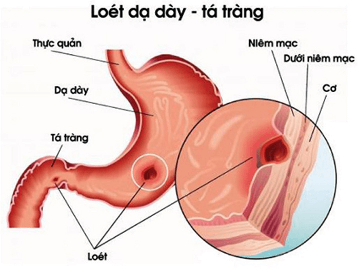 Đau thượng vị bên phải ngang rốn Đau thượng vị bên phải ngang rốn