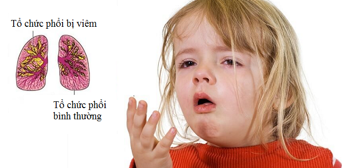 Viêm họng mủ ở trẻ em -3 Viêm họng mủ ở trẻ em -3