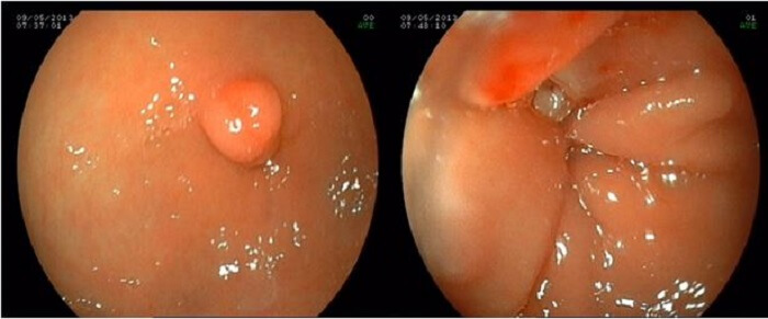 Nội soi dạ dày ống mềm hiện đại Nội soi dạ dày ống mềm hiện đại