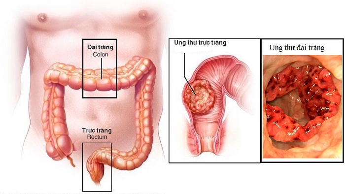 tầm soát ung thư đại tràng - trực tràng ở đâu tầm soát ung thư đại tràng - trực tràng ở đâu