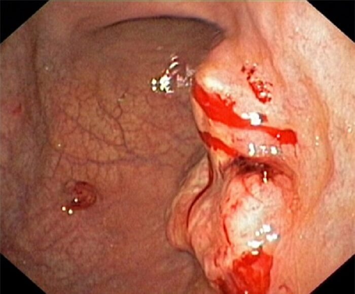Polyp dạ dày nguy hiểm Polyp dạ dày nguy hiểm