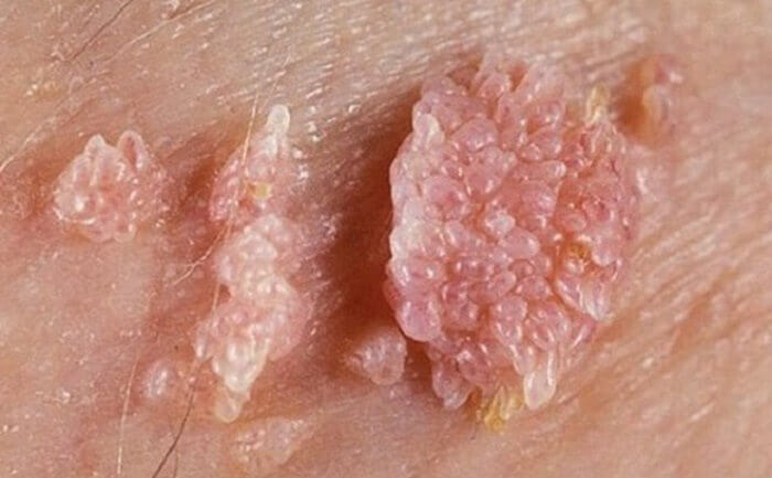 Xét nghiệm virus HPV Xét nghiệm virus HPV