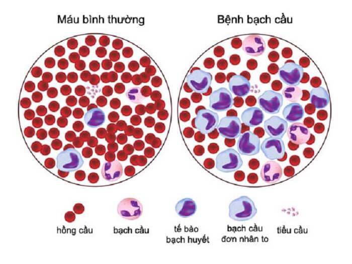 Chỉ số xét nghiệm máu Wbc có ý nghĩa gì? Chỉ số xét nghiệm máu Wbc có ý nghĩa gì?