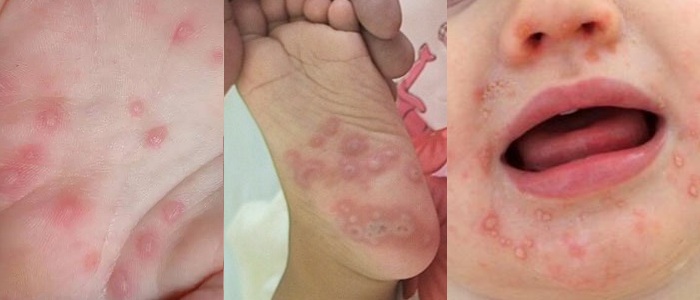 trẻ bị tay chân miệng có bị lại không trẻ bị tay chân miệng có bị lại không