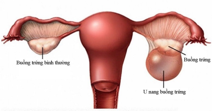 Đau bụng dưới bên phải Đau bụng dưới bên phải