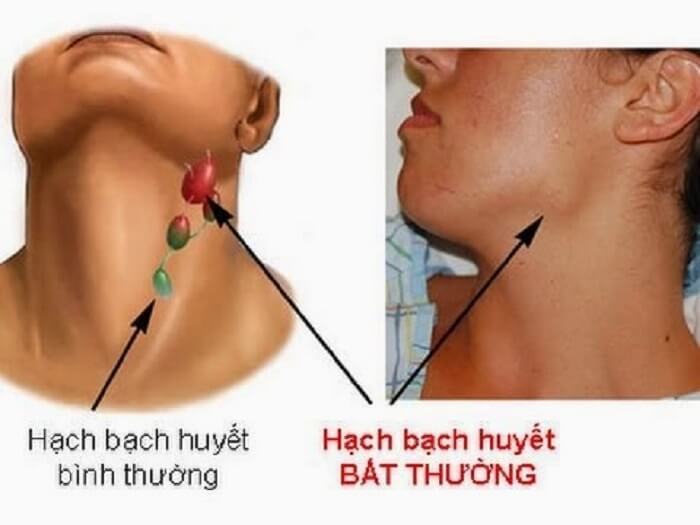 Triệu chứng HIV Triệu chứng HIV