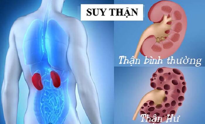 Xét nghiệm ure máu là gì 1? Xét nghiệm ure máu là gì 1?