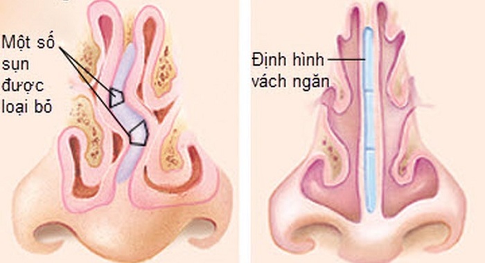 lệch vách ngăn mũi -3 lệch vách ngăn mũi -3