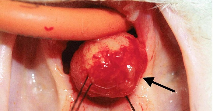 Polyp mũi -3 Polyp mũi -3