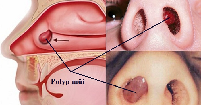 Polyp mũi Polyp mũi