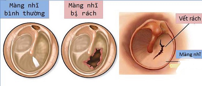 Thủng màng nhĩ Thủng màng nhĩ