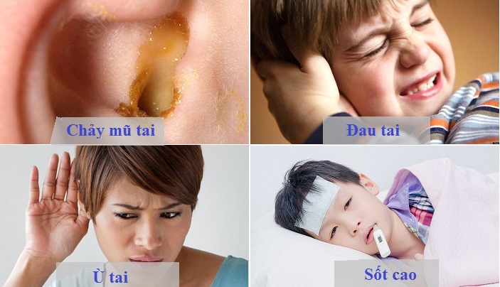 viêm tai giữa -2 viêm tai giữa -2