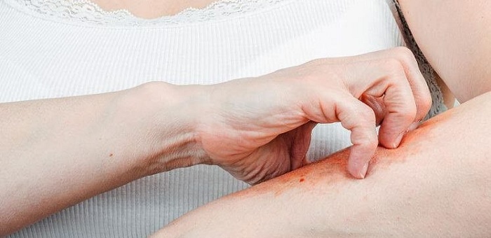 Ghẻ nước -3 Ghẻ nước -3