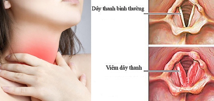Viêm thanh quản Viêm thanh quản