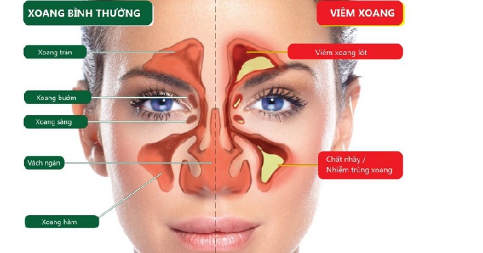 Viêm mũi dị ứng -2