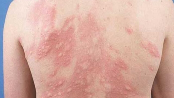 Xét nghiệm kí sinh trùng chính xác Xét nghiệm kí sinh trùng chính xác
